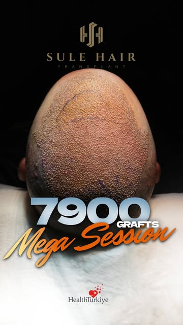 Mega Session | 7,900 Grafts ✨
A carefully planned Mega Session designed to address extensive areas o
