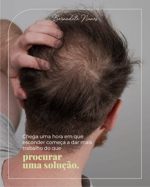 O tempo gasto tentando disfarçar a calvície começa a pesar
mais do que a própria mudança no cabelo.
