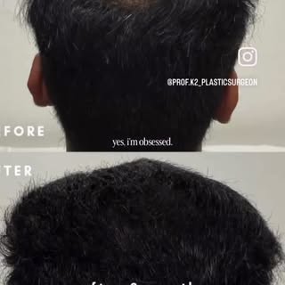 HAIR CARE AND HAIR RESTORATION, both Surgical and Non-surgical. #hair #hairtransplant #hairgoals #ha