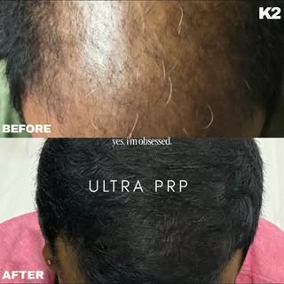 HAIR CARE AND HAIR RESTORATION, both Surgical and Non-surgical. #hair #hairtransplant #hairgoals #ha
