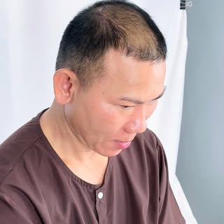 3,000 Grafts Next!! 

#bhiclinic #hairtransplantbangkok #bhiclinicbangkok #hairtransplantclinicsnear