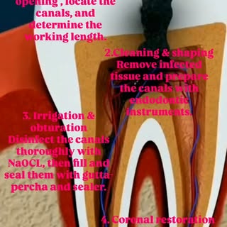 Root canal treatment 🦷
.
.
.
.
.
#dentaltreatment #rootcanal #dentalclinic #dentalcare
