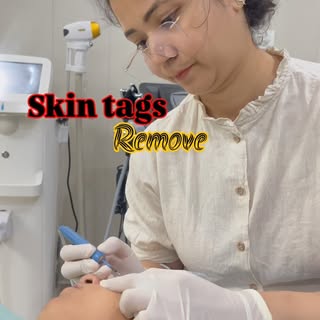 Skin tags remove ✨
#skintags #moleremove #skincare
