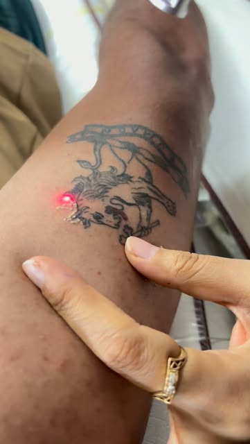 Tattoo laser removal ✨
#TattooRemoval #LaserTattooRemoval #LaserTreatment #TattooRemovalTreatment #S
