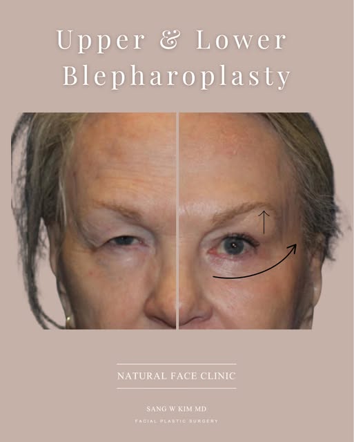 Upper and lower blepharoplasty can create a more refreshed, rested appearance while preserving the n