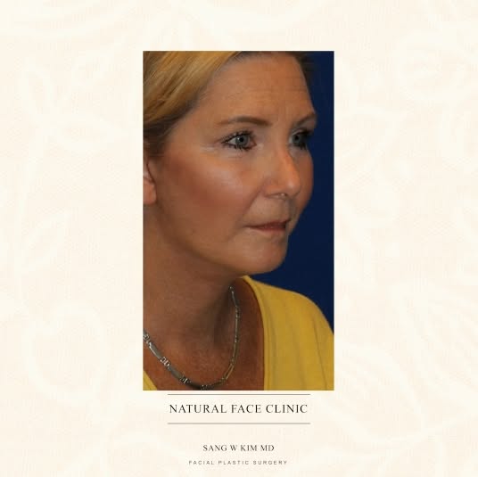 It’s less about correcting the face, and more about understanding the patient. Dr. Kim has performed