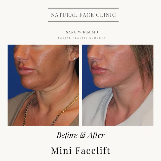Subtle changes can make a meaningful difference. This mini facelift was designed to address early si