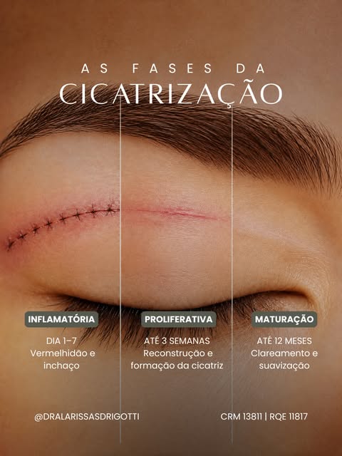 Sua cicatriz está vermelha, inchada ou mais aparente do que você esperava? Calma. Isso pode fazer pa