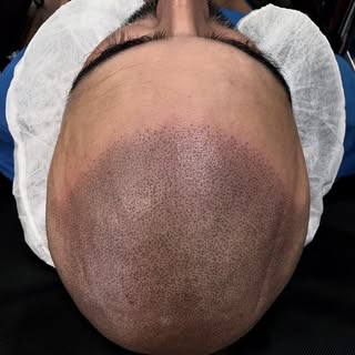 3 sessions and you’ve got a new hairline. The redness goes away within 24 hours and you’re off and r