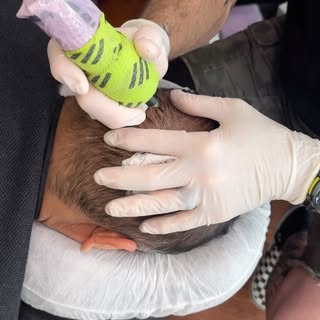 Third session on this FUE scar cover up and density client. He had 3 hair transplants and significan