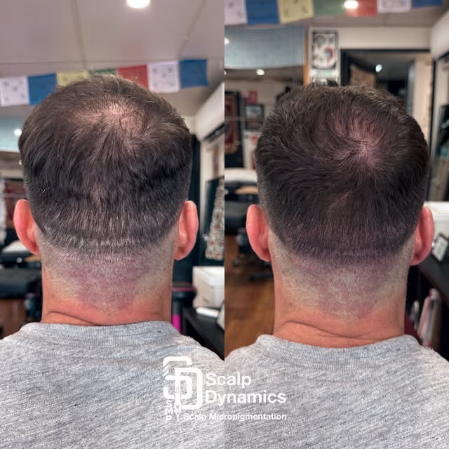 First session on this FUE and FUT scar camouflage plus a little crown density. Thanks for coming in!