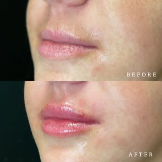 Lips to SWOON over 🫦

Dr. Turnure used 1 syringe of JUVÉDERM® Ultra XC to give this patient a fulle