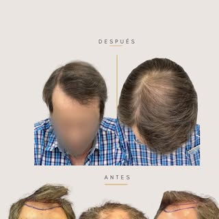 😳 La alopecia no solo cambia tu cabello… también cambia cómo te ves y cómo te sientes.
Por eso, cua