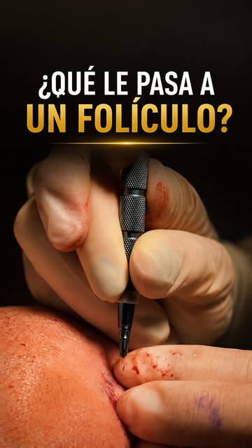 Esto es lo que pasa con un folículo… 🔬

Detrás de cada injerto capilar hay un proceso preciso para 