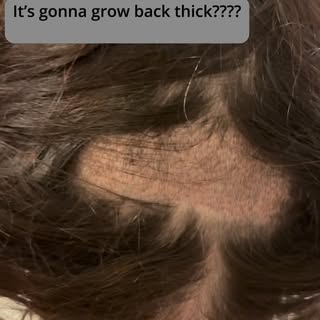 She Just Did A Hair Transplant 

Window shaving FUE requires the donor area at the back of the head 