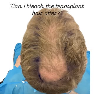 Of course you can bleach transplant hair same as native hair!

Some surgeons are afraid of the crown