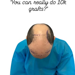 The work I have done on this scalp has taken close to a full working week 

Pleased to have recently