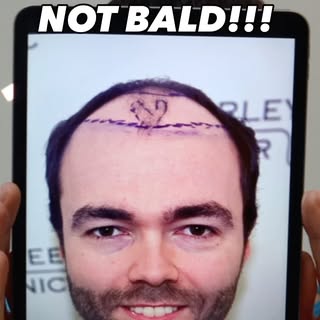 In this video I explain my thought process behind the treatment plan for this Norwood 5/5a patient!!