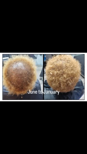 💕 Get ready for hair goals! A holistic approach featuring laser therapy, scalp massage, and tailore