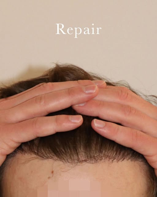 A 30-year-old patient came to us after a failed hair transplant left him with an unnatural hairline.