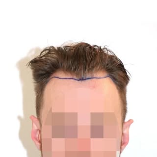 A hair transplant shouldn’t be noticed, it should simply feel right.

🎥 Watch the transformation
#d