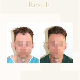 A natural hairline can quietly change everything.
This before & after shows the result of a carefull