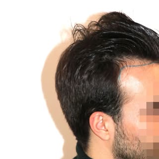 Before. After. Naturally.
A hair transplant by Dr. Feriduni is never about changing who you are, it’