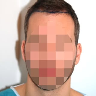 The best results don’t look done.
FUE hair transplant with 2808 grafts, before & after�by Dr. Feridu