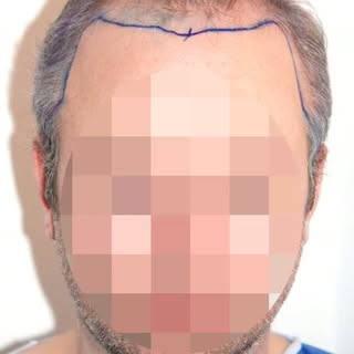 Natural. Undetectable. Timeless.
This patient's transformation was achieved with 3651 FUE grafts, re