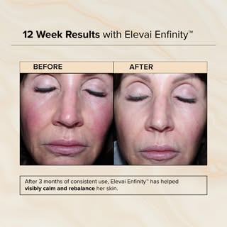 After consistent use, Elevai Enfinity™ has helped visibly calm and rebalance the skin, supporting a 
