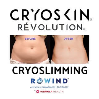 Book your FREE consultation for #CryoSkin. Tighten your skin, lose weight!

-33.3% in WAIST BULGE 😮