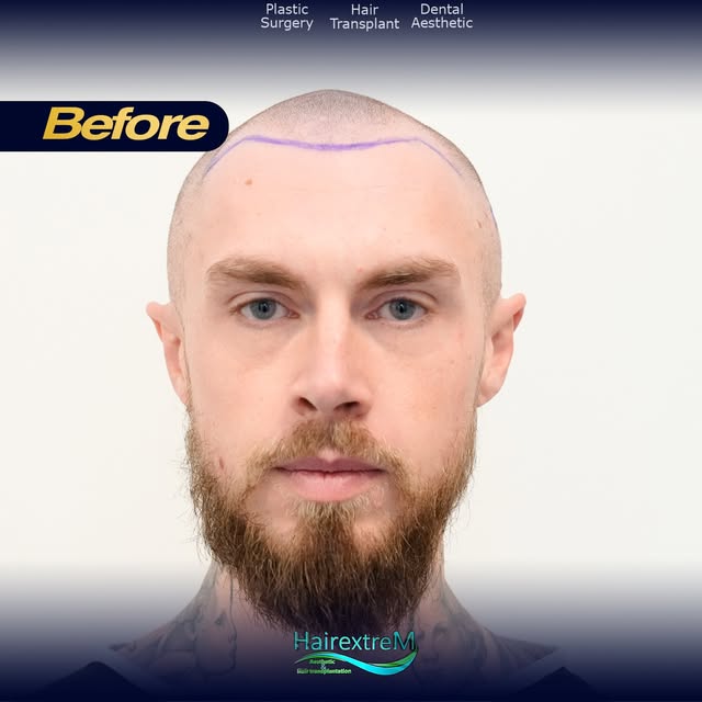 🇫🇷 💥Voici  les photos de Georges avant sa greffe de cheveux, réalisée il y a 9 mois.
Demain, déco