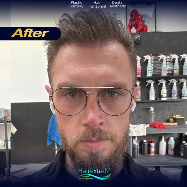 🇫🇷💥La greffe de cheveux réalisée il y a 8 Mois reste tout aussi naturelle aujourd’hui !
Nous part