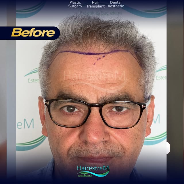 ⏳ 2 Years Ago…

Today, we’re looking back at the beginning of Mr. Binali’s hair restoration journey.