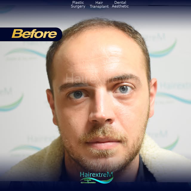 🇫🇷 Le parcours de Julien avec HairextreM…

Venu de France, Julien a choisi HairextreM en 2021 pour