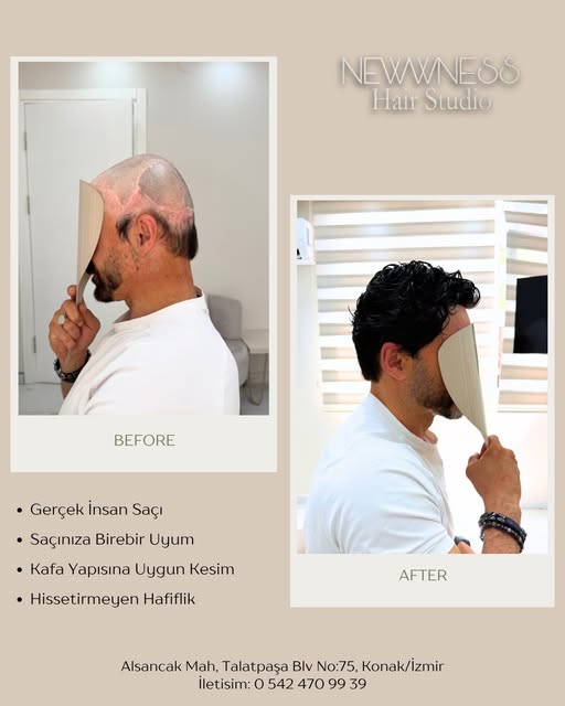 Bazı izler hayatımızın bir parçası olabilir… 🤍
Önemli olan, kendinizi yeniden iyi hissetmeniz.

New