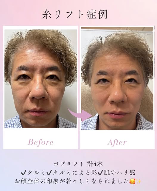 👨‍⚕️✨

＼糸リフト始めました✨／

今回は
宮部先生がモデルに✨

ボブリフト4本使用

✔たるみ改善✨
✔たるみによるシワ改善✨
✔お肌のハリ感アップ✨

フェイスラインもすっきり