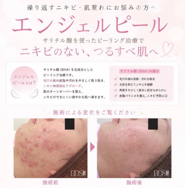 👨‍⚕️✨

繰り返すニキビ・肌荒れに👼🏻✨

サリチル酸（BHA）を使用した
「エンジェルピール」✨🫶

毛穴の皮脂や古い角質を取り除き、
肌のターンオーバーを整えることで
ニキビのできにく