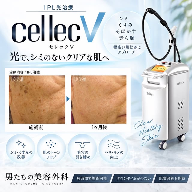 セレックVは様々なフィルターを使い
シミ・毛穴や小じわ、ハリ感を出したり
様々なお悩みに対応できる機械です✨

レーザー治療とは違い、ダウンタイムが少ないのも特徴です🤗
ご体験もご用意しておりますの