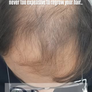 They said it was too late...
They thought it’d cost a fortune.

But guess what?
Hair regrowth doesn’