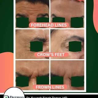 Celebrate this festive season with a wrinkle-free glow! See the magical before-after effects of botu