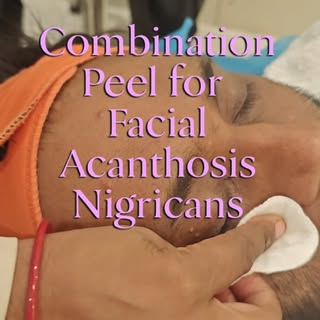Facial acanthosis presents as dark, thick, velvety skin patches, often linked to insulin resistance 