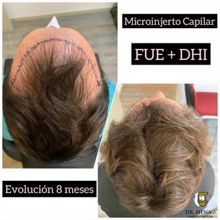 Microinjerto Capilar con a Tecnica FUE + DHI Reconstrucción Zona Frontal , Evolución a los 8 meses. 