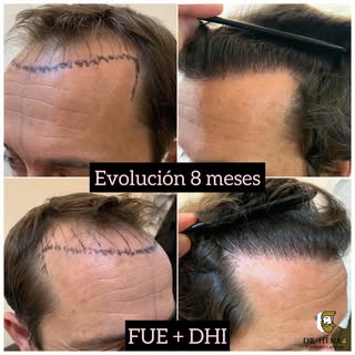 Microinjerto Capilar con a Tecnica FUE + DHI Reconstrucción Zona Frontal , Evolución a los 8 meses. 