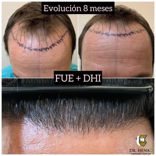 Microinjerto Capilar con a Tecnica FUE + DHI Reconstrucción Zona Frontal , Evolución a los 8 meses. 