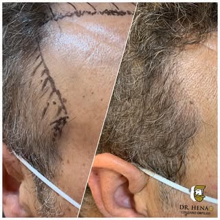 Microinjerto Capilar Tecnica FUE + DHI, Reconstrucción Trisngulos Temporales Antes y Después 

#inje