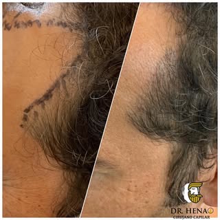 Microinjerto Capilar Tecnica FUE + DHI, Reconstrucción Trisngulos Temporales Antes y Después 

#inje