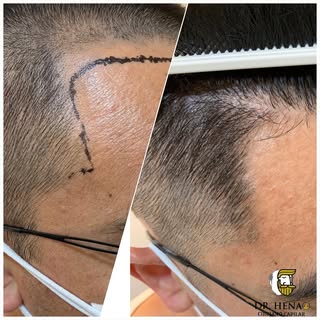 Microinjerto Capilar Tecnica FUE + DHI, Reconstrucción Trisngulos Temporales Antes y Después 

#inje