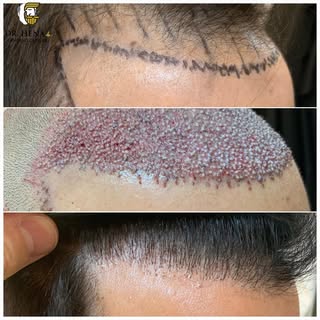 Reconstrucción de Línea Frontal. Microinjerto Capilar. Antes y Después 

#injertocapilar #trasplante