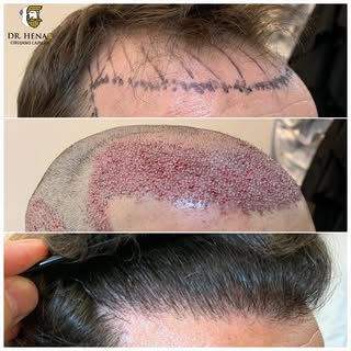 Reconstrucción de Línea Frontal. Microinjerto Capilar. Antes y Después 

#injertocapilar #trasplante